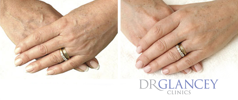 Hands before and after dermal fillers