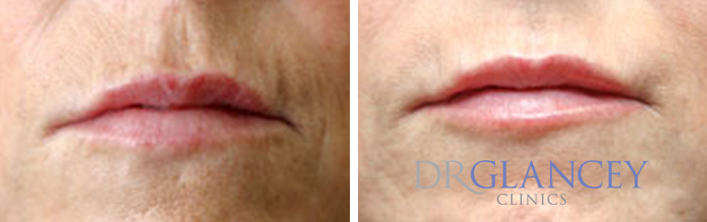 dermal fillers section lips before and after
