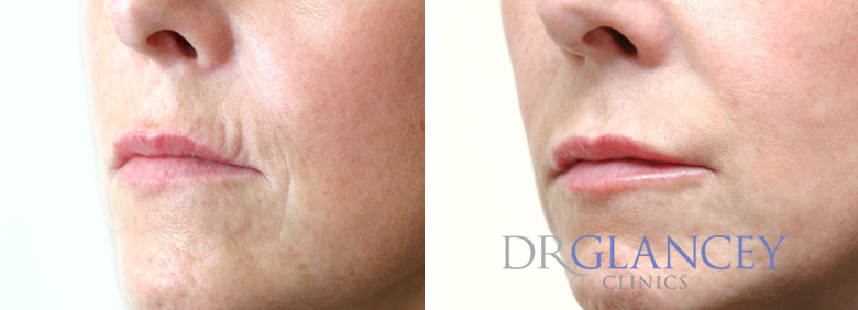 lips before and after 1 dermal filler section